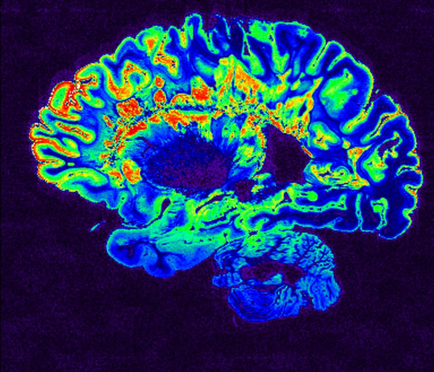 Colour-coded quantitative MRI parameter map